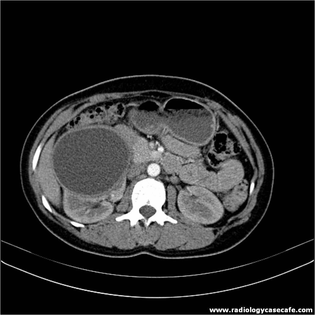 Abdomen Radiology Case Cafe