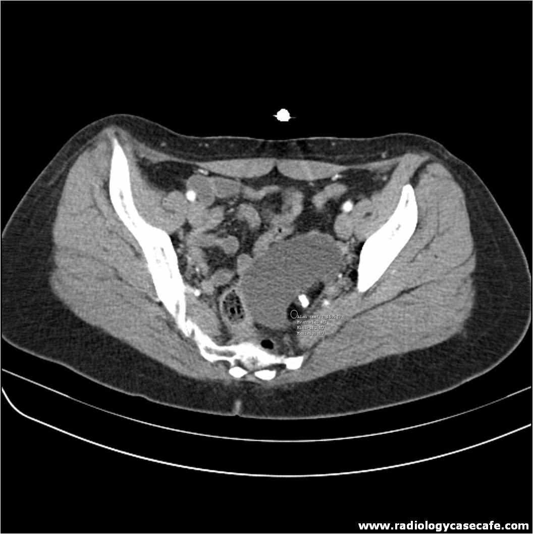 Abdomen - Radiology Case Cafe