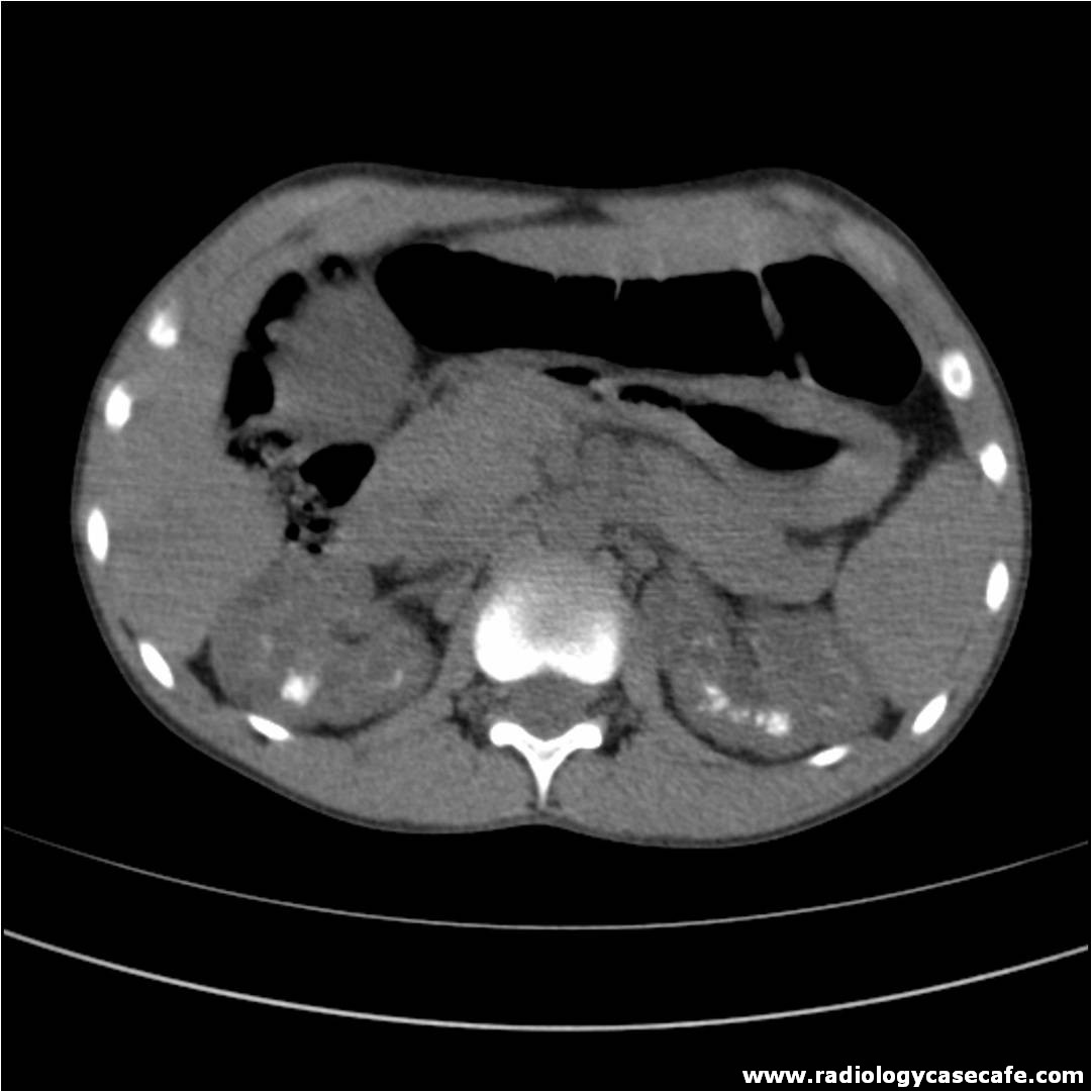 Abdomen - Radiology Case Cafe